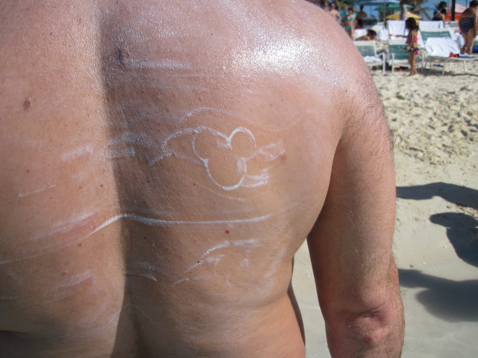A Mickey shape traced in sunscreen on Michael's back