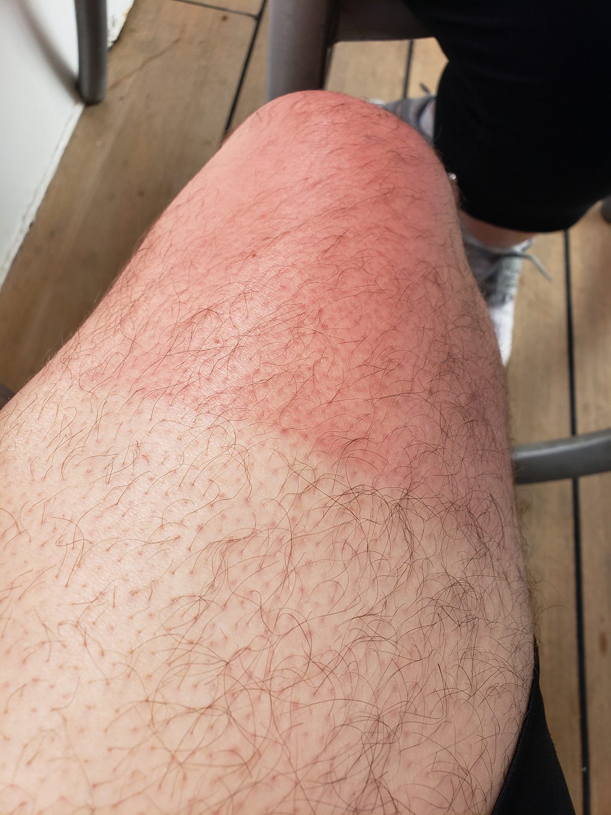 My sunburned legs, impossible to ignore