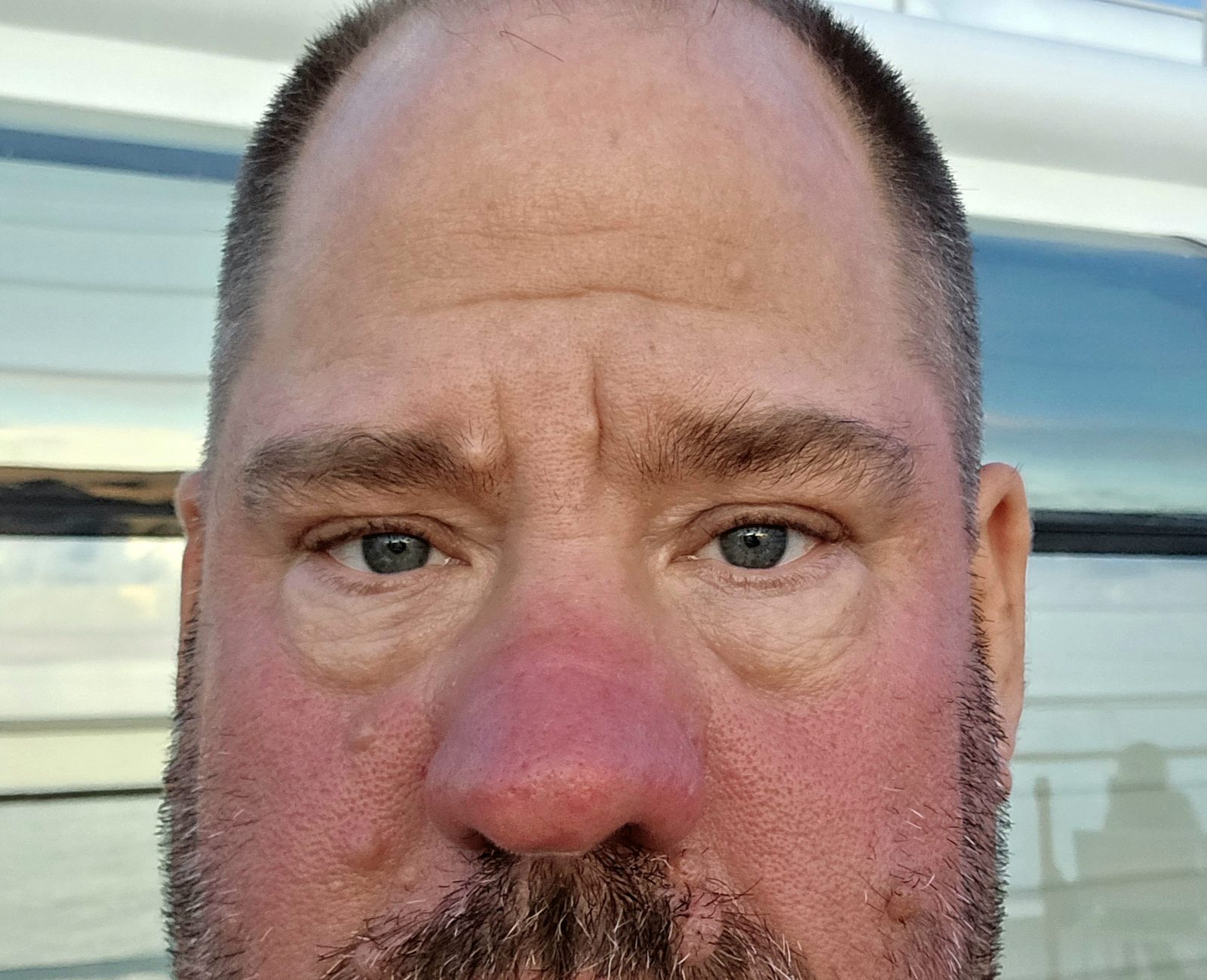 My sunburn by the end of the day